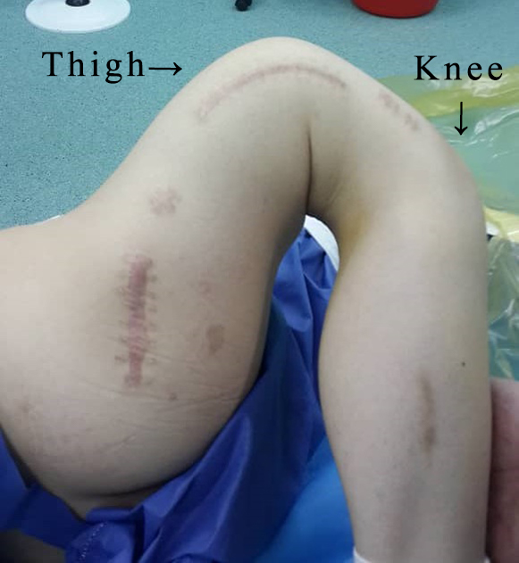 Femoral Intramedullary Bent nail Deformity